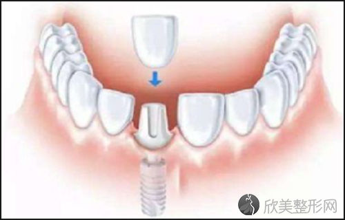 补牙和种牙哪个好？补牙材料有多种选择