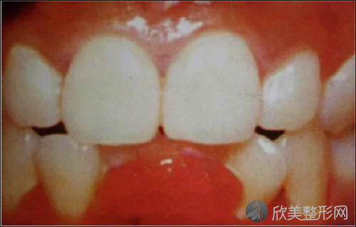 治疗牙龈增生哪个科比较好？牙龈增生改善方法要学会