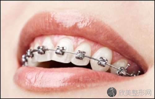 牙齿自锁托槽ormco与3m哪个贵？牙齿自锁托槽矫治过程中有许多注意事项