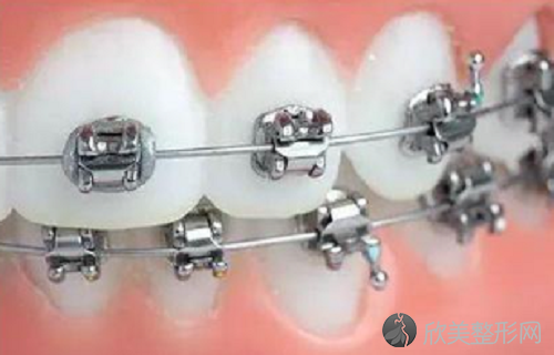 牙齿自锁托槽ormco与3m哪个贵？牙齿自锁托槽矫治过程中有许多注意事项