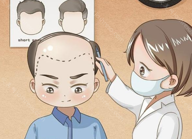 广州南方医院植发口碑怎么样?植发医生详情揭秘!