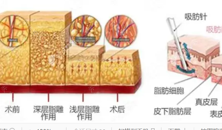 南方医院泰成分院整形外科吸脂多少钱?水动力吸脂11377元起，技术到位!