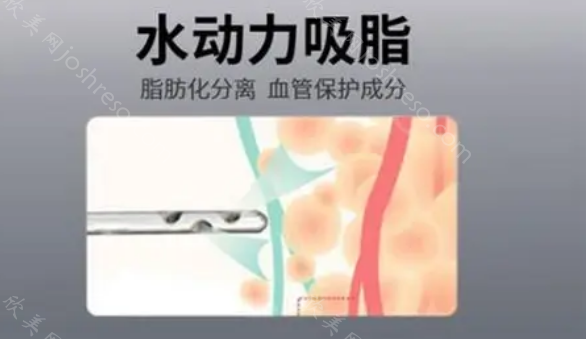 中山爱思特整形医院吸脂技术好不好?吸脂医生技术特点介+价格揭晓!