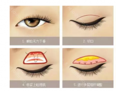 宁波艺星医疗美容医院整形价格：2023新版发布+双眼皮整形优势