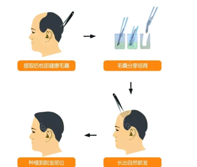 福州大麦微针植发医院怎么样?医院/医生介绍+五大植发技术揭晓!