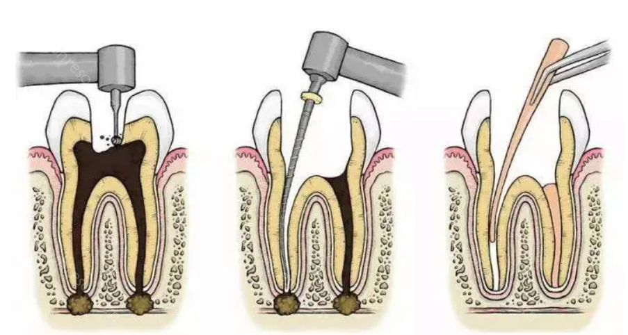 什么样的牙齿需要根管治疗?附根管治疗图片，及根管治疗步骤对牙齿的影响!