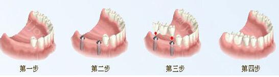 福州种植牙价格表大全上线啦,含各国进口植牙价格及口碑医院推荐!