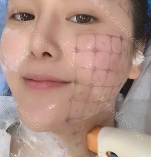 南宁瑞柏美医疗美容门诊部热玛吉怎么样?热玛吉技术特色和项目案例点评!