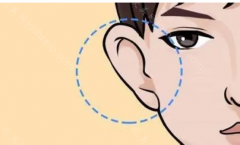 什么是招风耳矫正?招风耳矫正的方法是什么?