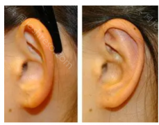 精灵耳从外形上看有什么不一样？精灵耳手术有哪些风险呢?