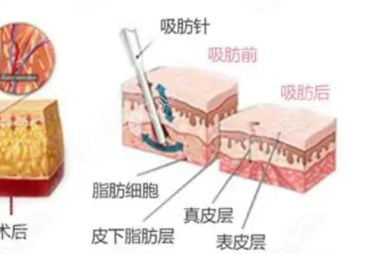 南宁华美赵广生吸脂怎么样?吸脂技术在线，损伤小，满意度高，价格不贵!