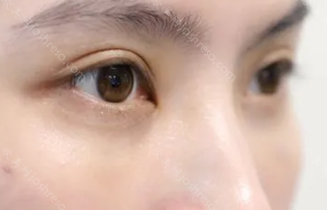 西京医院祛眼袋技术怎么样?实力医生在线公布，附带眼部整形价格表!