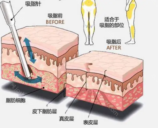 杭州丽脂医疗吸脂怎么样?医院技术特色揭晓，附吸脂价格!