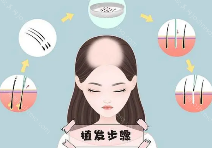 杭州艺星植发技术怎么样?正规植发，技术可靠!