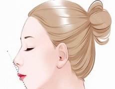 乳白天使注射隆鼻可持续多久?出现移位如何修复?