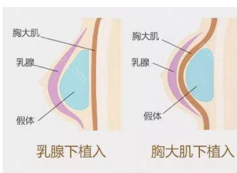 广州艺星蒋思军做下皱襞隆胸手术怎么样?手术效果符合人体美学标准!