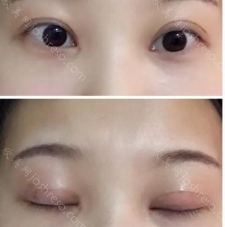 杭州西美医疗美容双眼皮整形怎么样?双眼皮整形有哪些技术特色?