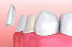 为避免做了牙贴面后悔怎么样?收藏牙贴面有哪些优点和缺点?