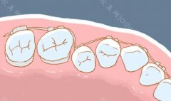 牙龈萎缩是什么原因导致的? 点击查看相关的原因及护理方法