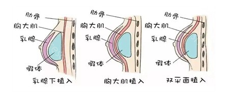 大理华美美莱隆胸技术可靠吗?夏国兴医生专业隆胸!