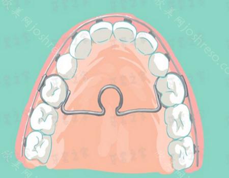 运动护齿牙套怎样选择?点击了解下牙套的选择方式有哪些?