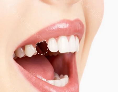 美国百好瑞种植体怎么样?术后应该如何护理牙齿?