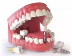 牙齿掉了十几年还能种植牙吗?种植牙的过程是怎么样的?