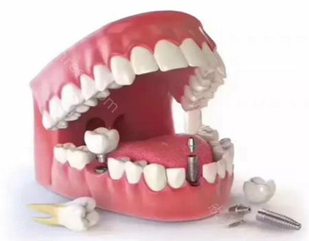 牙齿掉了十几年还能种植牙吗?种植牙的过程是怎么样的?