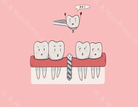 轻度贫血可以做种植牙吗?种植牙需要维护保养吗?
