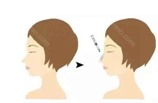 西昌艺佳美医疗隆鼻正规吗?隆鼻正规，医生擅长!