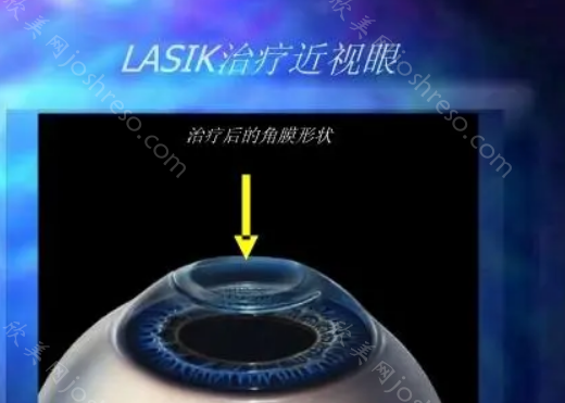 广州近视手术价格多少钱?2024价格表一览，口碑眼科医院推荐!