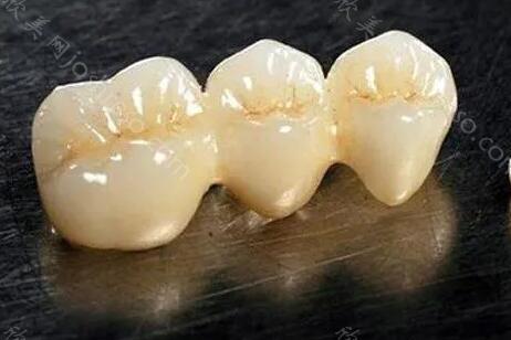 氧化锆全瓷牙的优缺点是什么?附相关的优缺点介绍