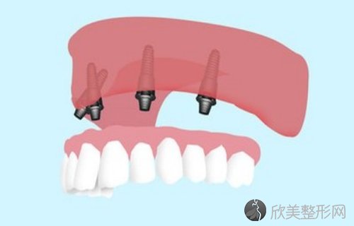 成都美蕊口腔正规吗？案例、价目表分享，口腔知识科普！