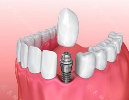 德国瑞钛种植体多少钱一颗?种植牙价格6800元起,科普维持时间