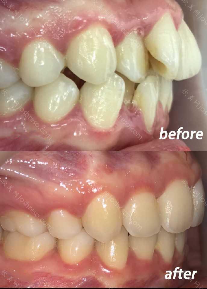 牙齿畸形主要有两种危害：局部和全身
