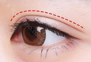 美杜莎双眼皮和普通双眼皮的区别是什么?原理/优势都不同|附注意事项