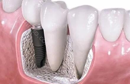 数字化种植牙和传统种植牙区别是什么?分享2款种植牙详情