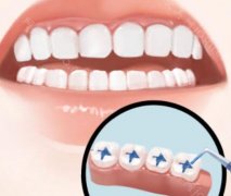 牙槽骨严重吸收还能种牙吗?分析种牙价格影响因素