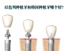 以色列种植牙和韩国种植牙的区别，从核心技术、产品特性、临床疗效进行对比