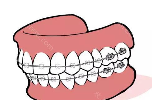 儿童牙齿提前干预的利弊是什么?速来看看相关的介绍