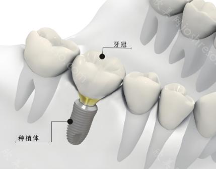 昆明口腔2024种植牙价格一览：昆明盘龙区与西山区种牙收费一览