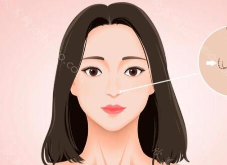 南宁维密整形隆鼻价格多少?整形小问答和价格咨询盘点