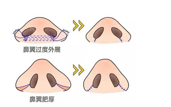 西安高一生医院隆鼻怎么样?陈伟、王恒医生隆鼻都很厉害