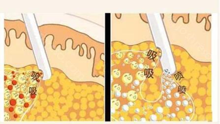 郑州欧华毋磊医生吸脂多少钱?面部1W起，大腿2.2W起