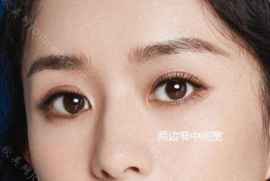 2024年郑州双眼皮手术收费表一览，附真人案例，医院名单分享