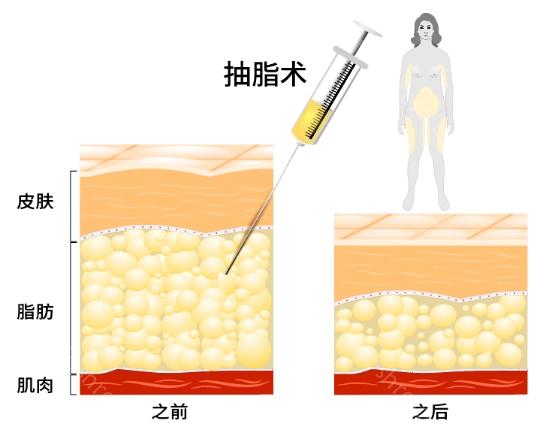 沈阳杏林整形做吸脂好不好?需要多少钱?汇总吸脂价格及医生介绍
