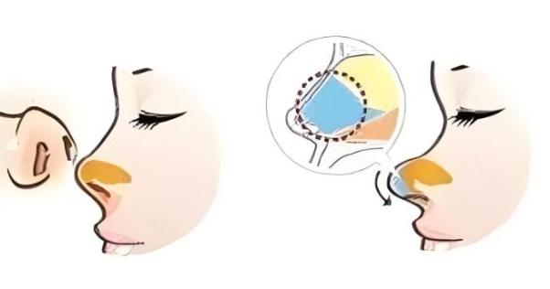 合肥壹加壹整形价格表公布：隆鼻/隆胸/双眼皮收费都可以查询