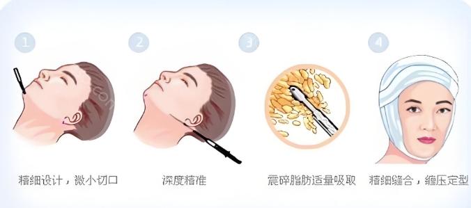 2024合肥恒美整形收费表公布：在线查询恒美双眼皮、隆鼻、隆胸等费用