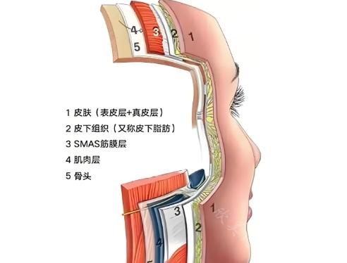 成都素美刘远程做筋膜提升好不好?技术好，效果好且持久