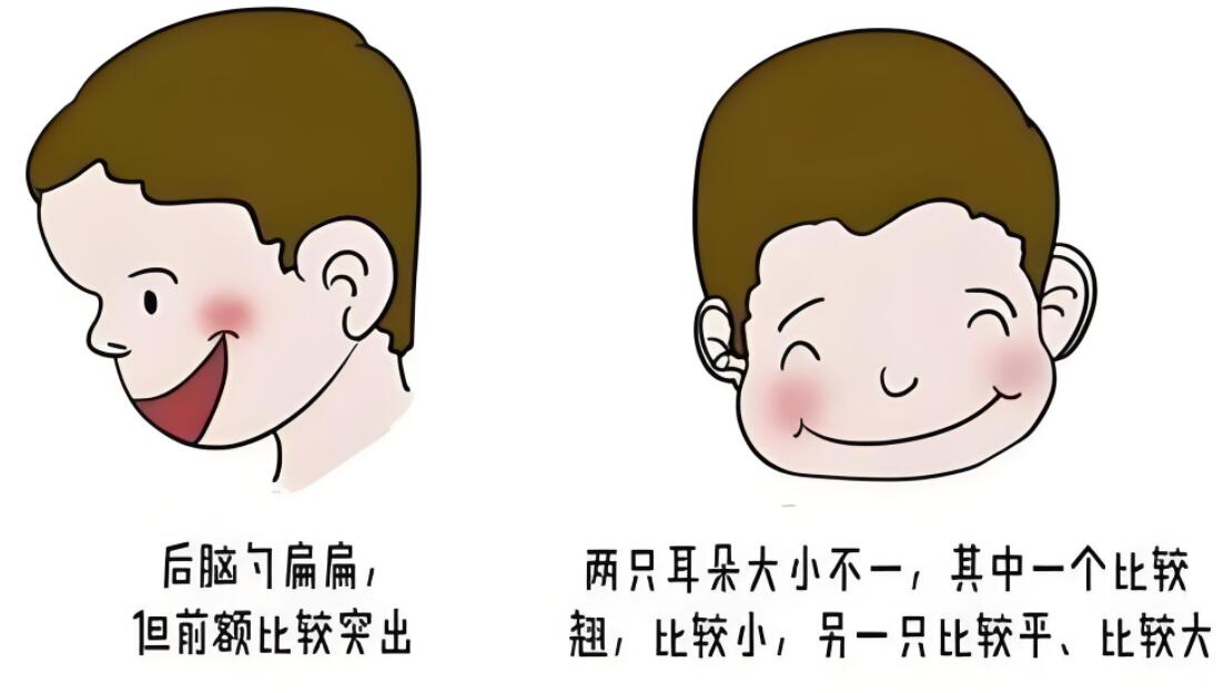 塑造青春容颜：玻尿酸填充与幼态脸美学重塑